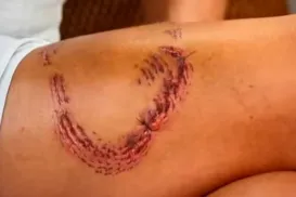 Turista revela marca de mordida de tubarão em Fernando de Noronha - Imagem