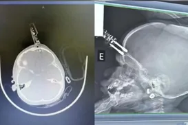 Bebê de 1 ano cai da cama e fica com carregador cravado na testa - Imagem