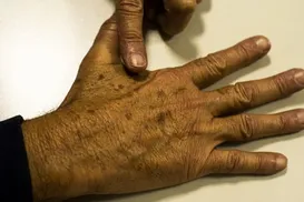 Casos de câncer em jovens adultos crescem 284% no Brasil - Imagem