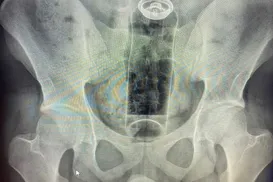 Jovem é internado com desodorante preso no reto - Imagem