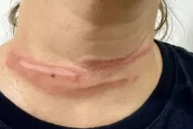 Mulher fica ferida após enroscar pescoço em fio preso a poste - Imagem