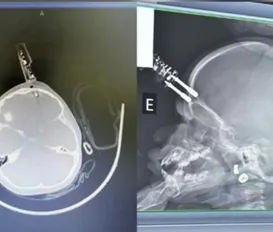 Bebê de 1 ano cai da cama e fica com carregador cravado na testa - Imagem