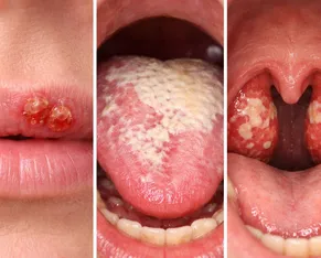 Alerta no Carnaval: Veja como o beijo pode transmitir doenças graves - Imagem