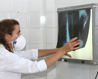 Brasil não atinge meta da OMS e tem aumento de casos de tuberculose