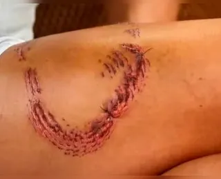 Turista revela marca de mordida de tubarão em Fernando de Noronha