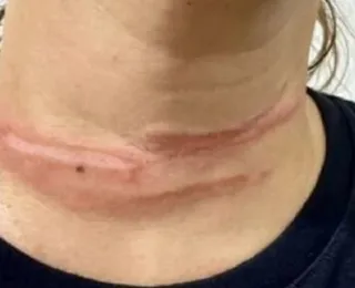 Mulher fica ferida após enroscar pescoço em fio preso a poste