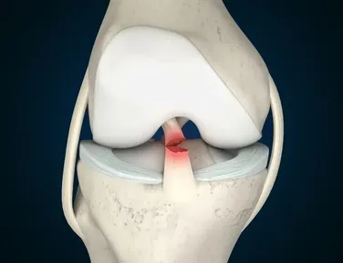 Por que o futebol feminino tem mais lesões de LCA que o masculino? - Imagem