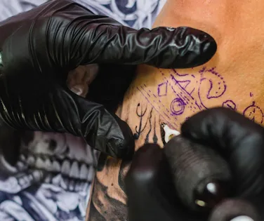 Homem passa por 7 cirurgias após apresentar alergia a tatuagem - Imagem