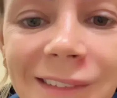 Influenciadora espreme espinha no rosto e vai parar no hospital - Imagem