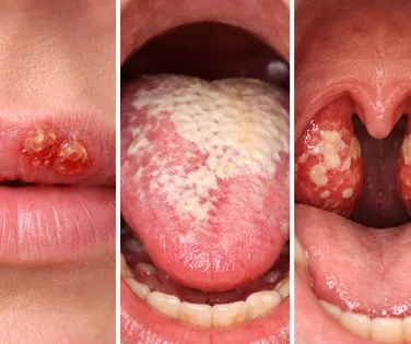 Alerta no Carnaval: Veja como o beijo pode transmitir doenças graves - Imagem