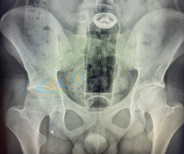 Jovem é internado com desodorante preso no reto - Imagem