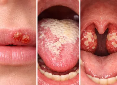 Alerta no Carnaval: Veja como o beijo pode transmitir doenças graves - Imagem