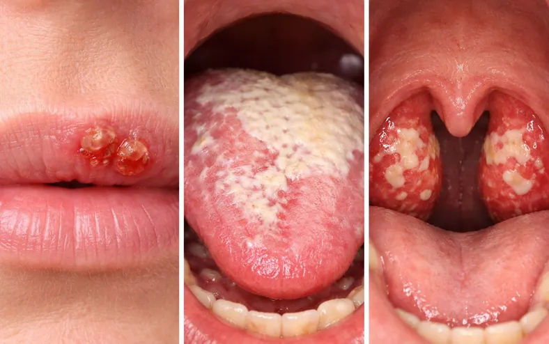 Alerta no Carnaval: Veja como o beijo pode transmitir doenças graves - Imagem