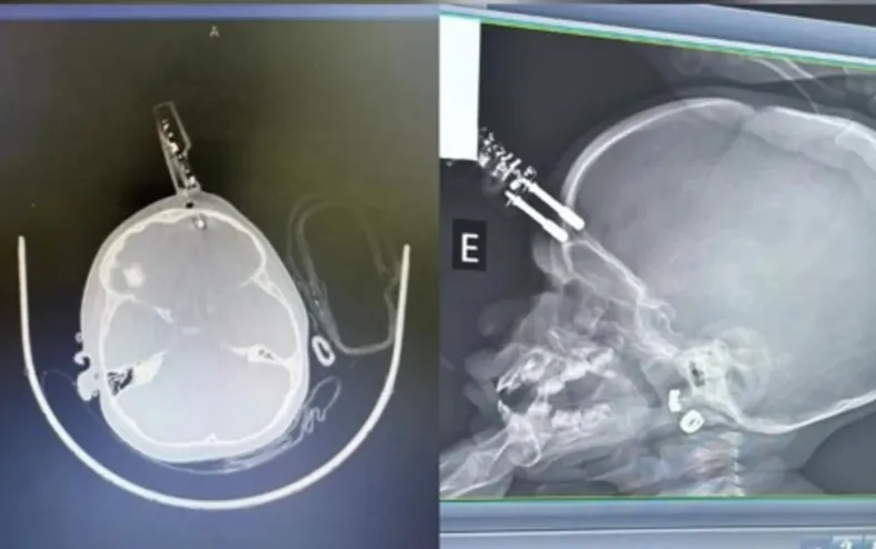 Bebê de 1 ano cai da cama e fica com carregador cravado na testa - Imagem