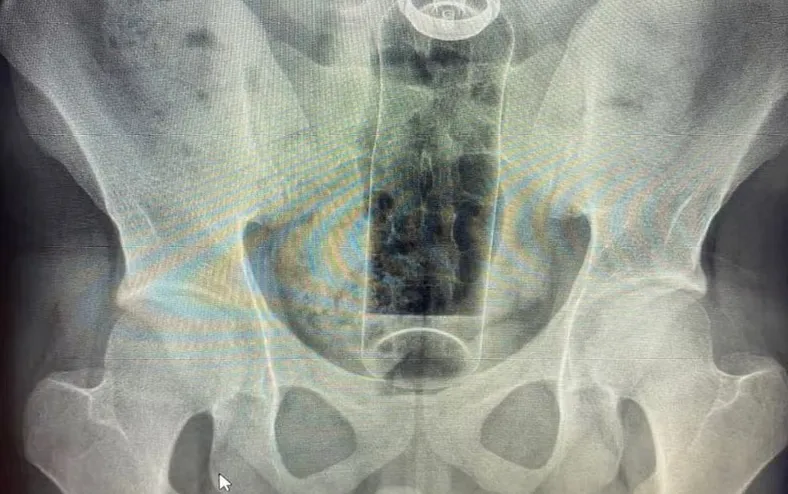 Jovem é internado com desodorante preso no reto - Imagem