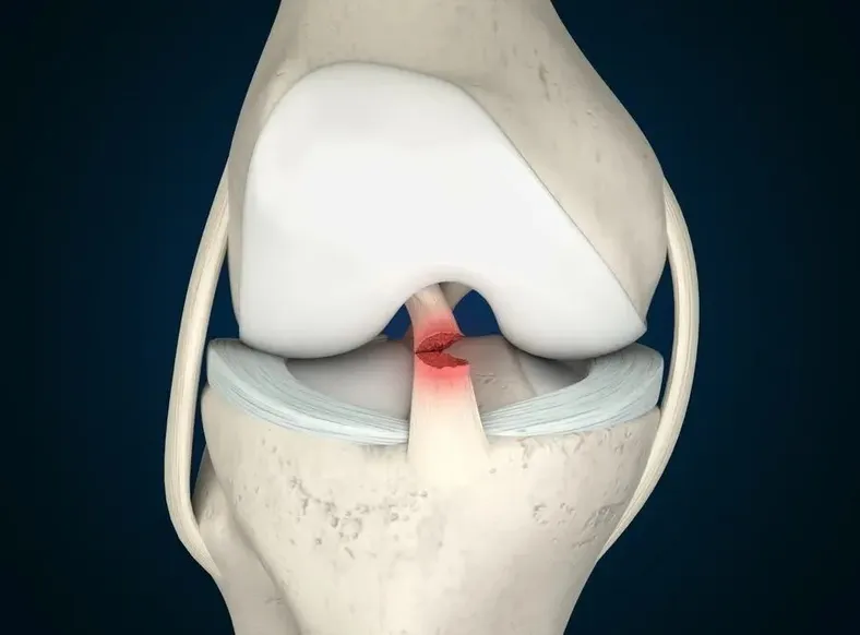 Por que o futebol feminino tem mais lesões de LCA que o masculino? - Imagem