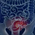 Câncer de intestino: veja sintomas e formas de prevenção imagem