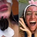 De sangue menstrual a vermes: saiba perigos dos procedimentos estéticos atuais imagem