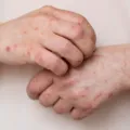Ministério da Saúde emite alerta máximo após avanço da Mpox no Brasil imagem