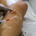 Mutirão gratuito realiza triagem para tratamento contra varizes imagem