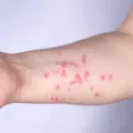 OMS alerta para nova variante da mpox; antiviral mais usado não mostra eficácia imagem