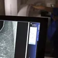 Teste genético que prevê risco de câncer de mama será feito no SUS imagem