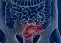 Câncer de intestino: veja sintomas e formas de prevenção