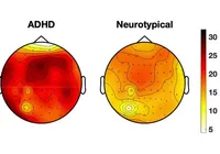 Cérebro de adultos com TDAH pode entrar em “modo sono”, diz estudo