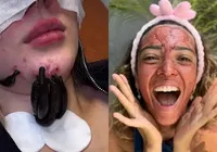 De sangue menstrual a vermes: saiba perigos dos procedimentos estéticos atuais imagem