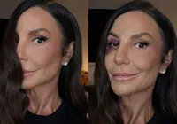 Ivete Sangalo desabafa sobre cirurgia delicada: “Quebrei dois ossos”