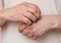Ministério da Saúde emite alerta máximo após avanço da Mpox no Brasil imagem