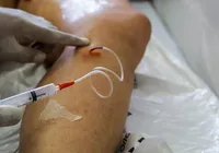 Mutirão gratuito realiza triagem para tratamento contra varizes imagem