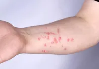 OMS alerta para nova variante da mpox; antiviral mais usado não mostra eficácia imagem