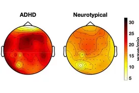 Cérebro de adultos com TDAH pode entrar em “modo sono”, diz estudo - Imagem
