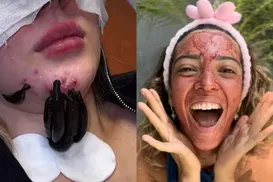 De sangue menstrual a vermes: saiba perigos dos procedimentos estéticos atuais - Imagem