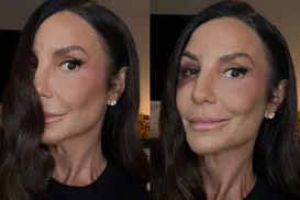 Ivete Sangalo desabafa sobre cirurgia delicada: “Quebrei dois ossos” - Imagem