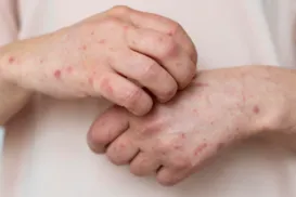 Ministério da Saúde emite alerta máximo após avanço da Mpox no Brasil - Imagem