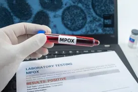 Mpox: Brasil chega a 90 casos com mais dois estados na lista - Imagem