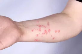 OMS alerta para nova variante da mpox; antiviral mais usado não mostra eficácia - Imagem