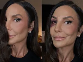Ivete Sangalo desabafa sobre cirurgia delicada: “Quebrei dois ossos” - Imagem