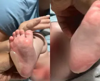 Bebê tem corpo queimado durante banho em berçário