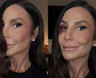 Ivete Sangalo desabafa sobre cirurgia delicada: “Quebrei dois ossos”