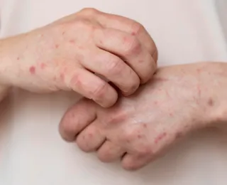 Ministério da Saúde emite alerta máximo após avanço da Mpox no Brasil