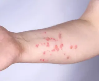 OMS alerta para nova variante da mpox; antiviral mais usado não mostra eficácia