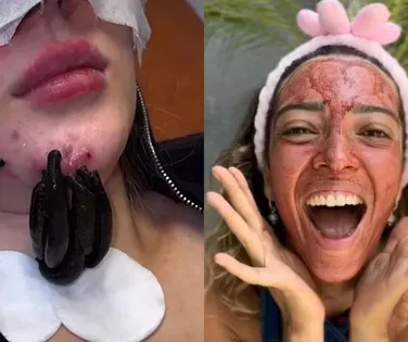 De sangue menstrual a vermes: saiba perigos dos procedimentos estéticos atuais - Imagem