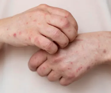 Ministério da Saúde emite alerta máximo após avanço da Mpox no Brasil - Imagem