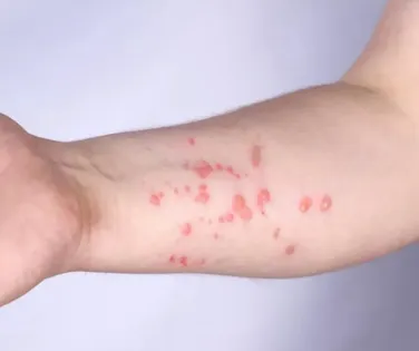 OMS alerta para nova variante da mpox; antiviral mais usado não mostra eficácia - Imagem