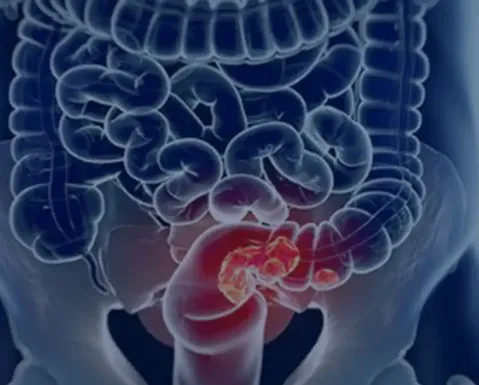Câncer de intestino: veja sintomas e formas de prevenção - Imagem