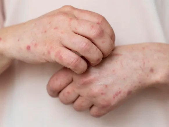 Ministério da Saúde emite alerta máximo após avanço da Mpox no Brasil - Imagem