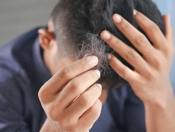 Minoxidil pode causar impotência? Veja o que dizem especialistas - Imagem